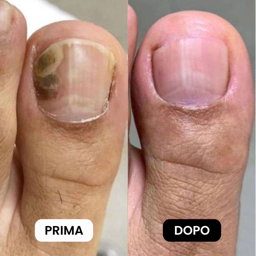 Penna Antifungina |  Risolvi la micosi in soli 10 minuti al giorno