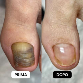 Penna Antifungina |  Risolvi la micosi in soli 10 minuti al giorno