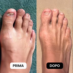 Penna Antifungina |  Risolvi la micosi in soli 10 minuti al giorno