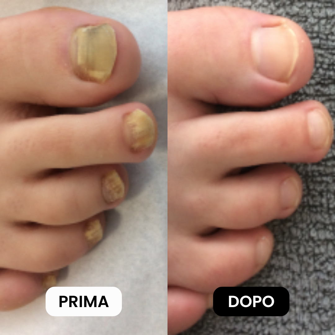 Penna Antifungina |  Risolvi la micosi in soli 10 minuti al giorno